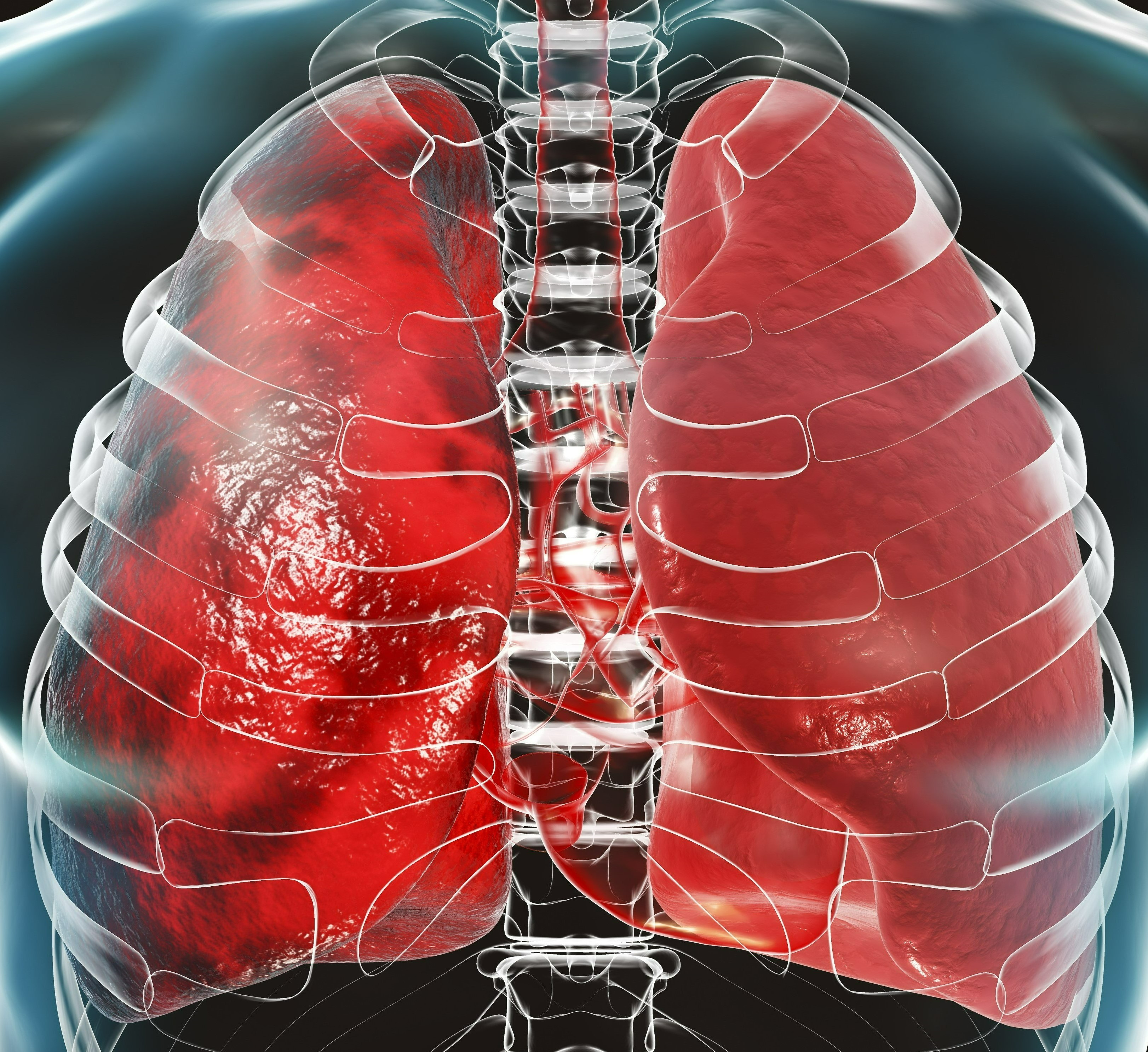 Pneumonia, lung infection, 3D conceptual medical illustration