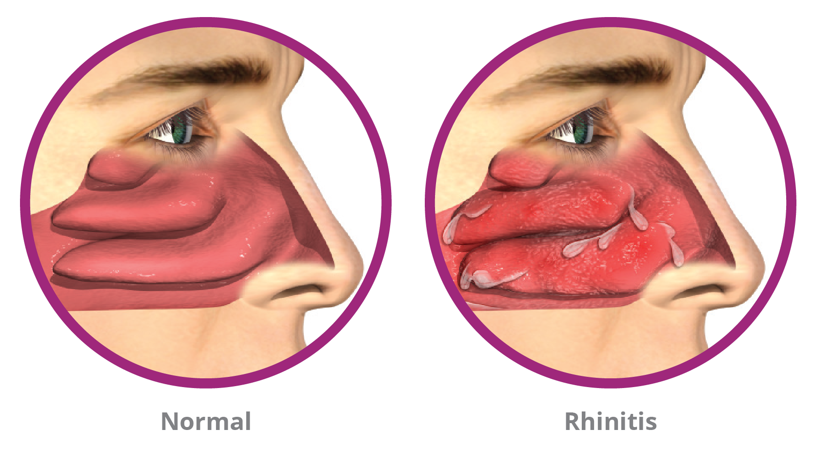 Rhinaer Normal vs Obstructed