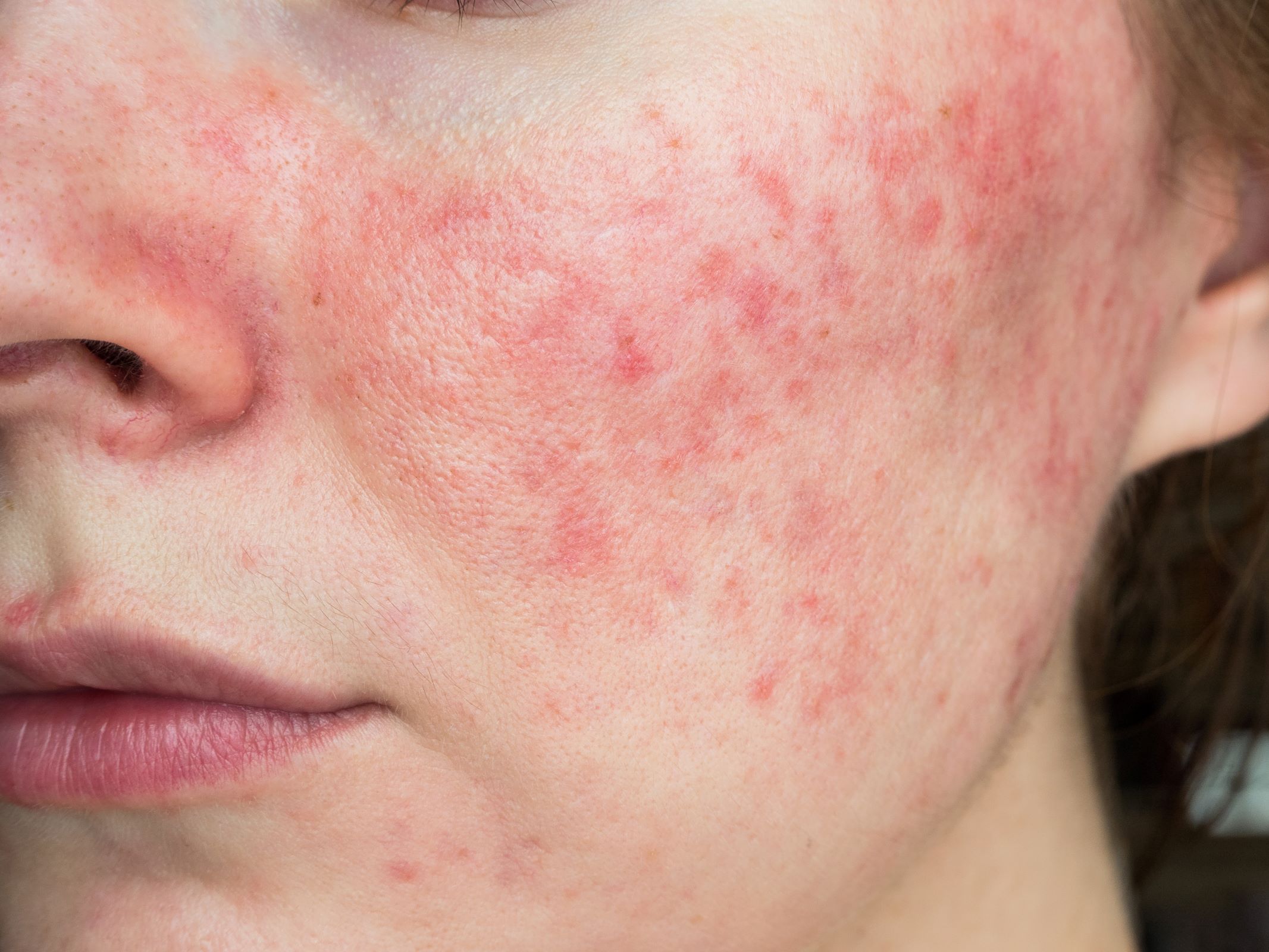 Rosacea AdobeStock 377499650