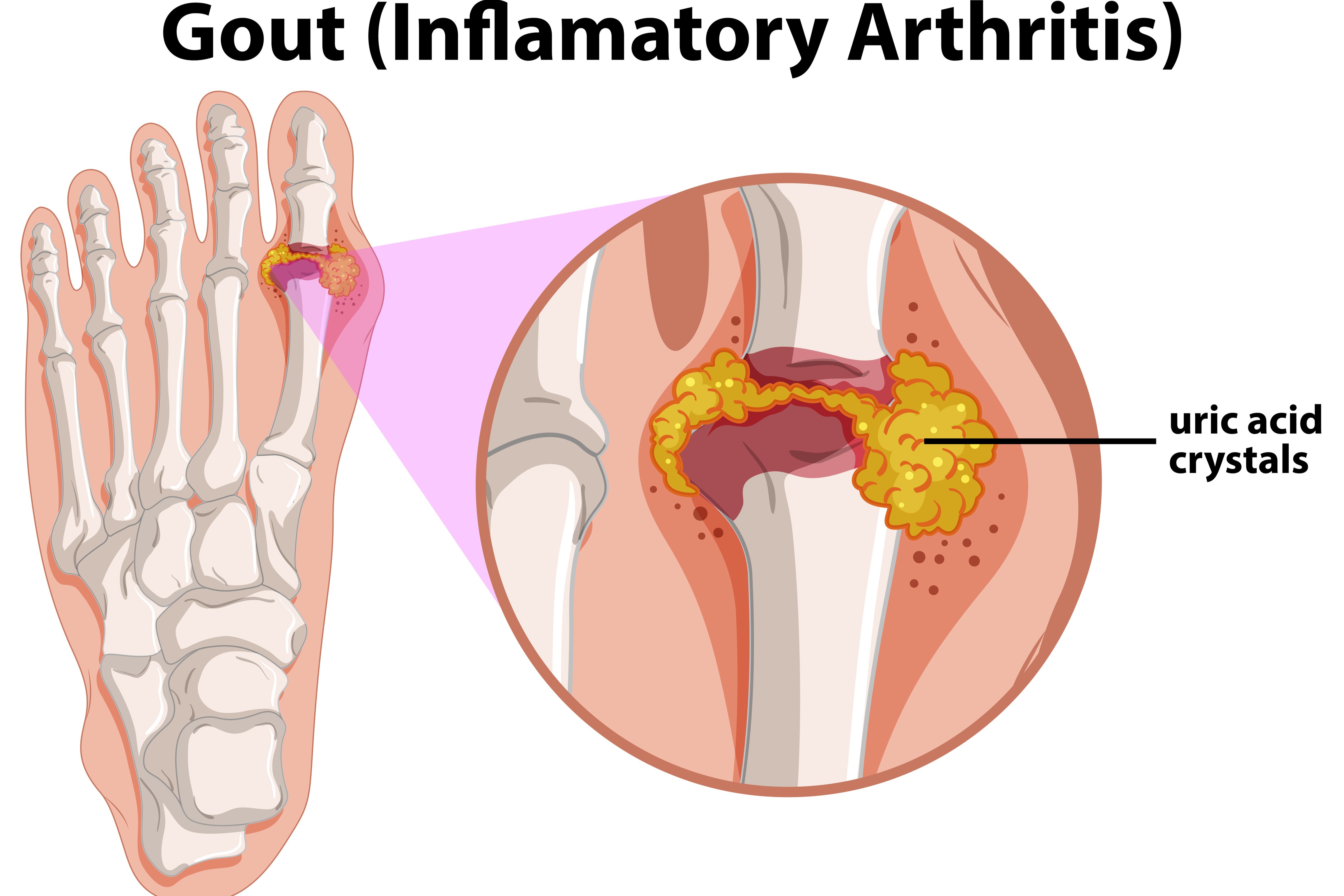 Diagram showing gout in human foot