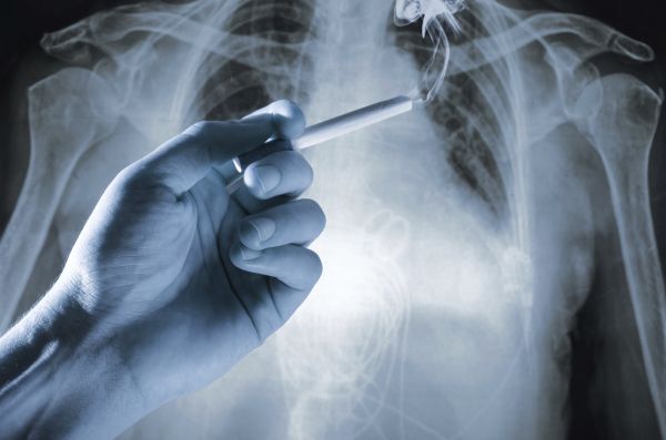 10 Facts About Lung Cancer